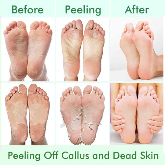 Foot Peel Mask,Exfoliator Peel Off Calluses Dead Skin Callus