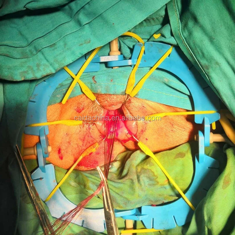 Surgical Abdominal Retractor Rectal Retractor Ring Lonestar Retractor
