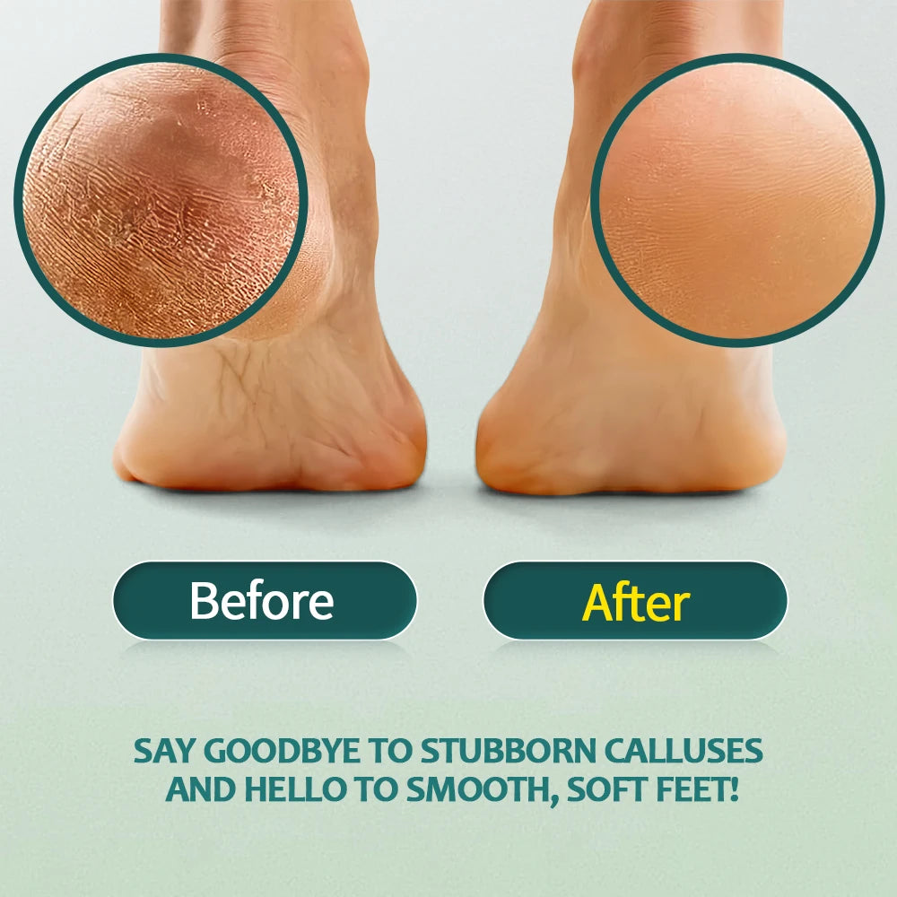 NAILPRO Extra Strength Callus Remover for Feet and Foot File Kit