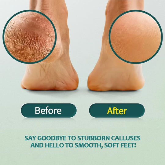 NAILPRO Extra Strength Callus Remover for Feet and Foot File Kit